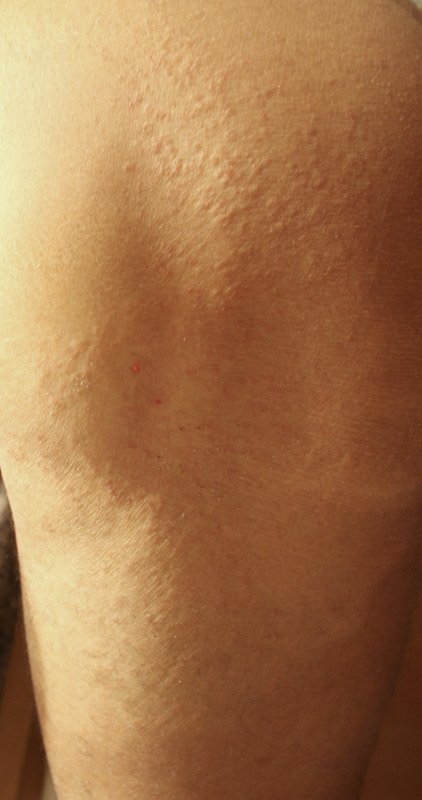 skin-fungus skin-fungus
