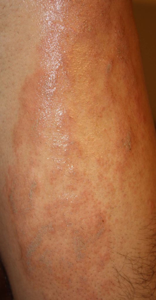 Autoimmune Rash